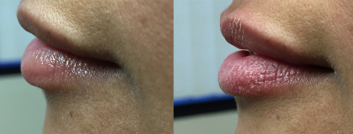 before and after treatment at Smiles Family Dental