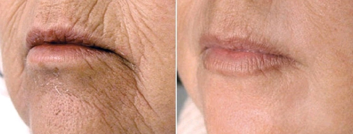 before and after treatment at Smiles Family Dental