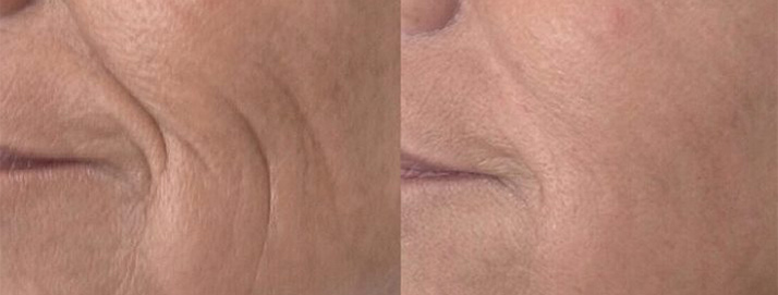 before and after treatment at Smiles Family Dental