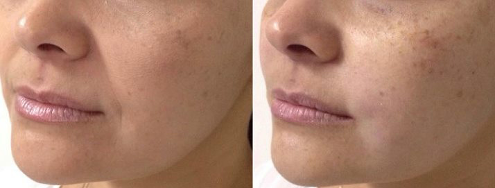 before and after treatment at Smiles Family Dental