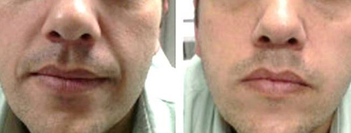 before and after treatment at Smiles Family Dental