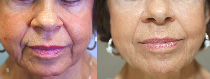 before and after treatment at Smiles Family Dental