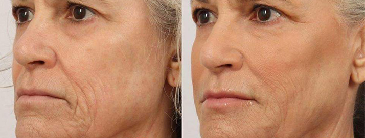 before and after treatment at Smiles Family Dental