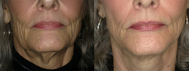 before and after treatment at Smiles Family Dental