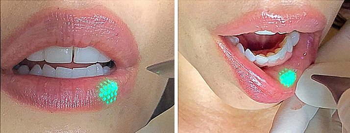 before and after treatment at Smiles Family Dental