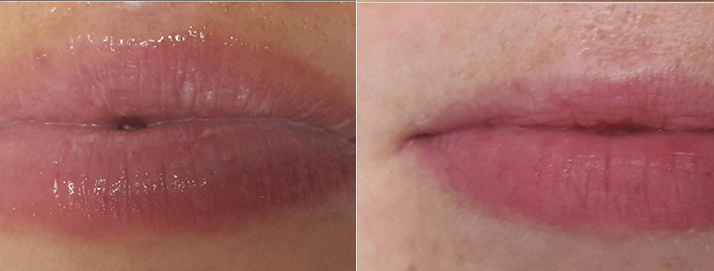 before and after treatment at Smiles Family Dental