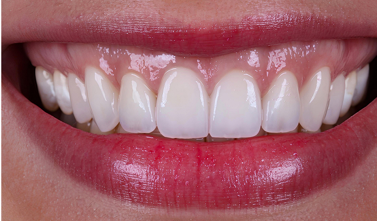 after treatment at Smiles Family Dental