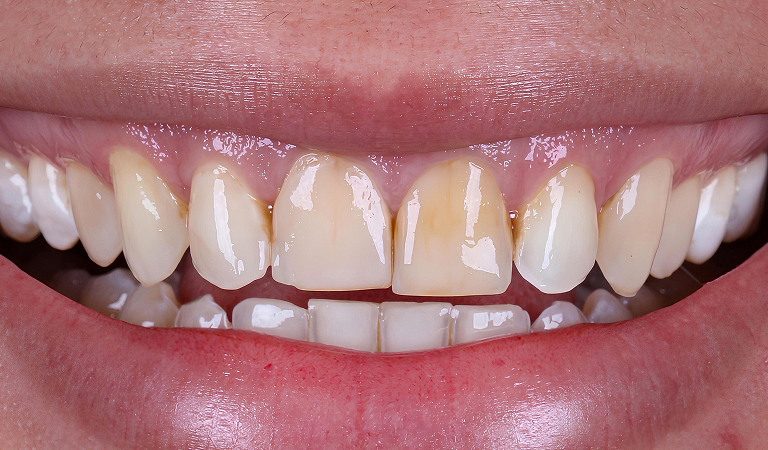 before treatment at Smiles Family Dental
